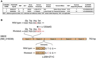 IDH1 as a Cooperating Mutation in AML Arising in the Context of Shwachman-Diamond Syndrome